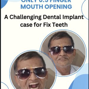 Fixed Teeth by Dental Implants–Patient Video Review | Dr. Bharat Agravat