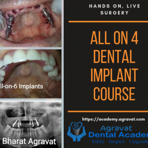 All on 4 Dental Implant Training Course, Hands On, Live Surgery in Ahmedabad Gujarat India