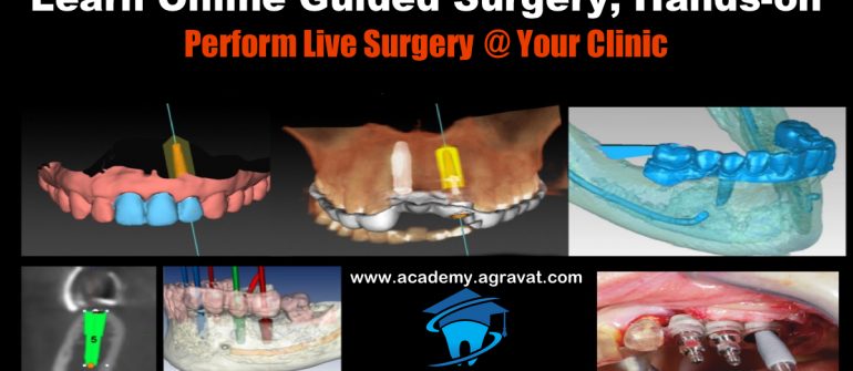 Guided Dental Implant Surgery